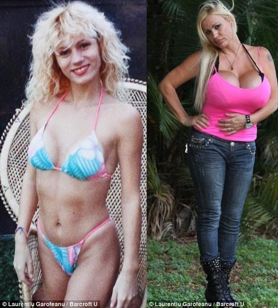 본문 이미지 - 1990년 첫번째 수술한 뒤 모습과 현재모습 (Laurentiu Garofeanu).© News1 