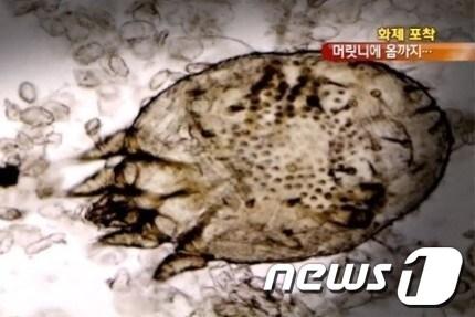 본문 이미지 - 머릿니를 확대한 모습/KBS 방송 화면 캡처/뉴스1© News1 