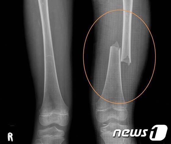 본문 이미지 - 2012년 5월 계모의 학대로 골절된 이양의 엑스레이 촬영 대퇴부 골절 사진. (울산울주경찰서 제공) © News1  