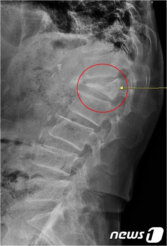 본문 이미지 - 압박골절로 인해 주저앉은 척추체ⓒ News1