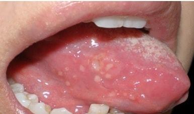 본문 이미지 - 혓바늘 (서울대학교병원 제공)© News1  