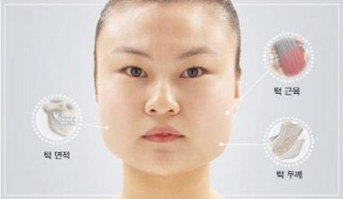얼굴 작아지는 법 사각턱 수술, 뼈 두께와 근육까지 고려해야 - 뉴스1