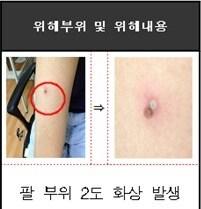 본문 이미지 - 아이폰 충전케이블로 인해 팔뚝에 입은 화상© News1  