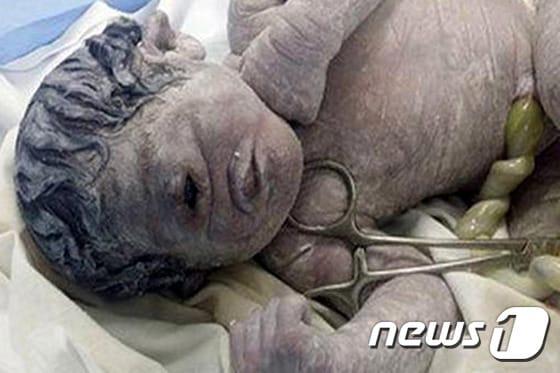 본문 이미지 - 이집트 북부에서 눈이 하나인 채 태어난 신생아의 모습.(출처=슬라티)ⓒ News1