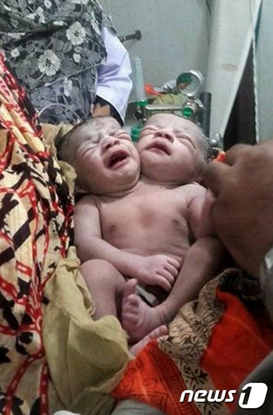 본문 이미지 - 지난 12일 방글라데시 브라만바리아에서 태어난 샴쌍둥이 여야의 모습.ⓒ AFP=뉴스1