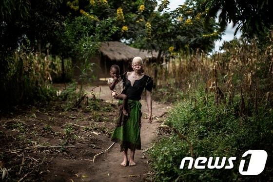 본문 이미지 - 말라위 마친가 지역에 사는 23세 알비노(백색증) 여성 마이나시 이사가 지난 4월 17일 2살배기 딸 드지아밀라 자팔리를 손에 앉고 서 있다. ⓒ AFP=뉴스1