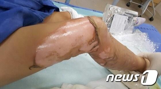 본문 이미지 - 사고 당시 B양의 화상 부위 ⓒ News1