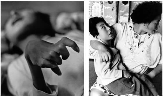 본문 이미지 - 제2차 세계대전 말 카드뮴 중독에 의한 이타이이타이 병 환자들