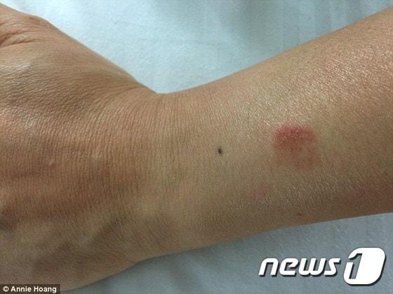 본문 이미지 - 애플워치로 인한 화상 자욱 (애니 황 트위터)ⓒ News1