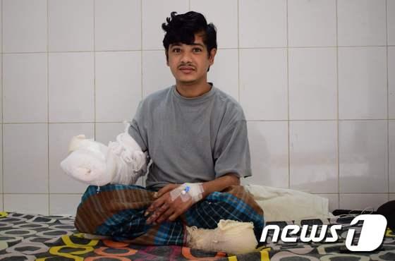 본문 이미지 - 지난 4일(현지시간) 1년간 16차례의 수술을 마치고 두 손을 쓸 수 있게 된 방그라데시의 아불 바한다르(27). 그는 피부가 사마귀로 뒤덮이는 희귀 질병을 앓고 있었으나 정부 지원으로 수술을 받게 됐다. ⓒ AFP=뉴스1