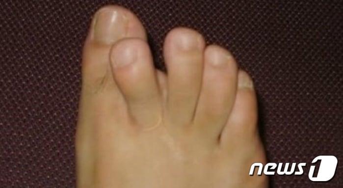 본문 이미지 - 무소속 원희룡 후보측이 공개한 사고로 기형이 된 원 후보의 발가락(원희룡 캠프 제공)ⓒ News1