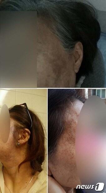 본문 이미지 - 헤나 방 시술 이후 피해자 모습들 ⓒ News1