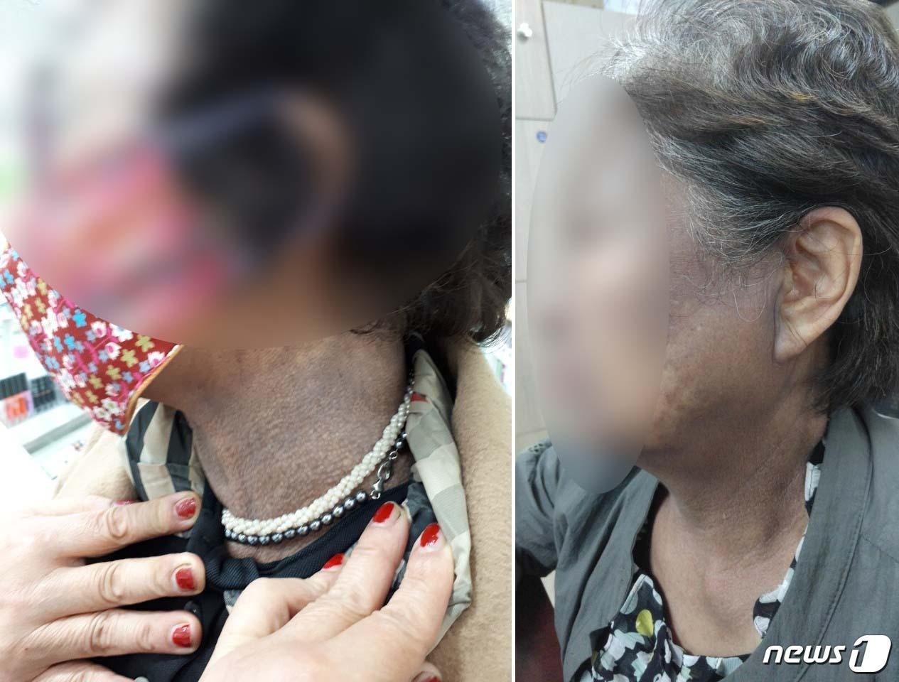 본문 이미지 - 헤나 방 시술 이후 피해자 모습들ⓒ News1