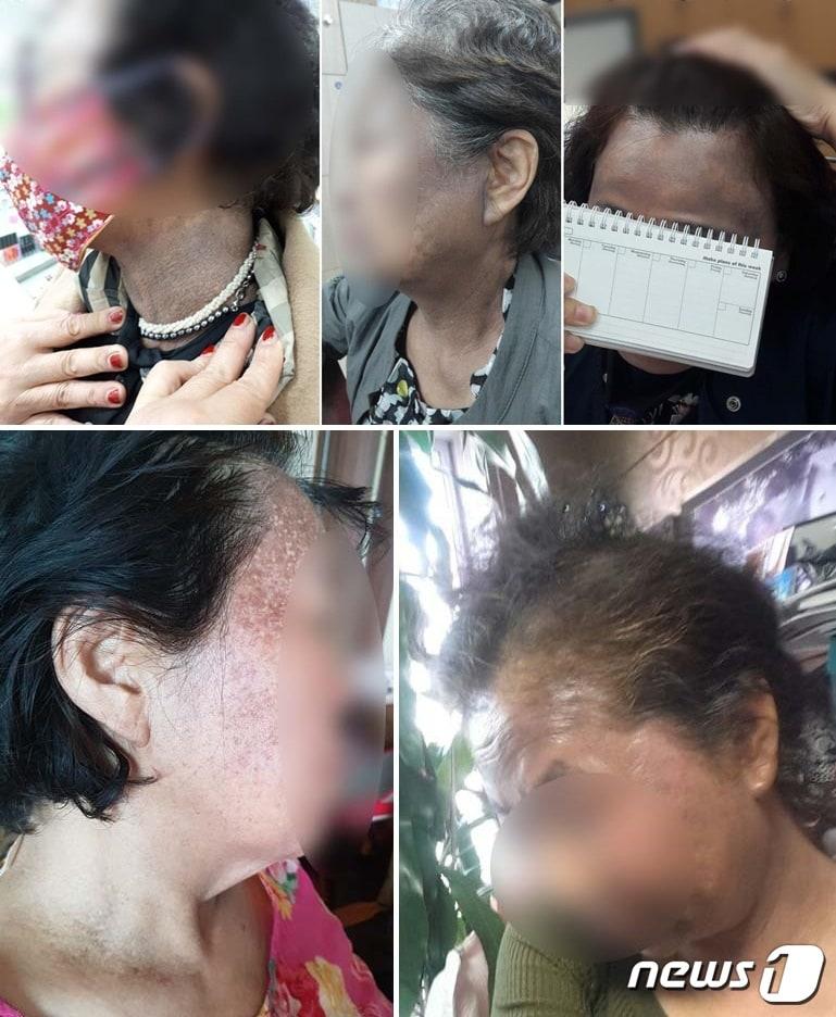 본문 이미지 - 헤나 염모제 사용 이후 부작용 사례 사진. ⓒ 뉴스1