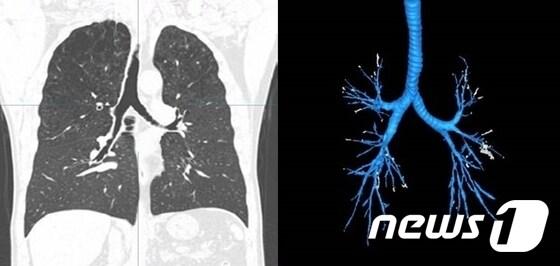 본문 이미지 - 만성폐쇄성폐질환(COPD) ⓒ 뉴스1