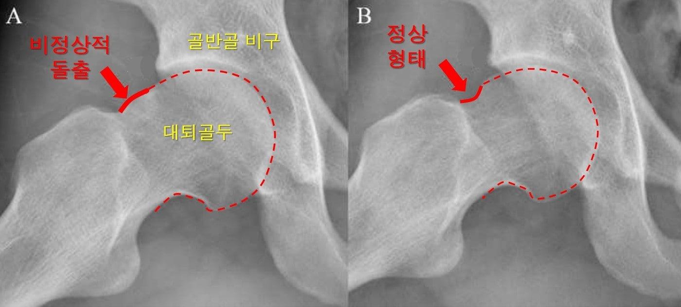 고관절 충돌증후군 환자의 관절경수술 전후 엑스선 영상(사진제공=서울아산병원)ⓒ 뉴스1