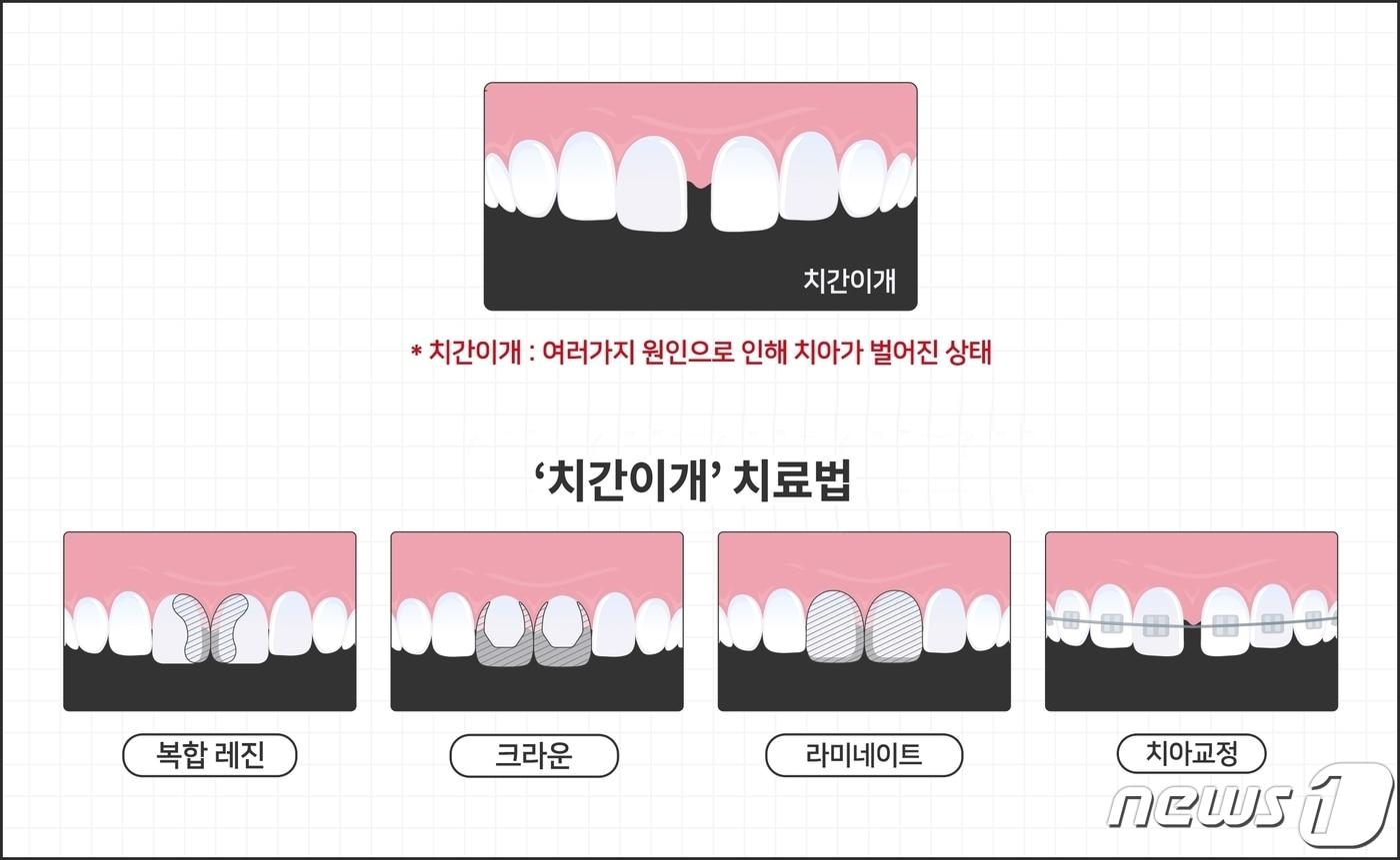 치간이개 치료법 (사진제공=유디치과)ⓒ 뉴스1