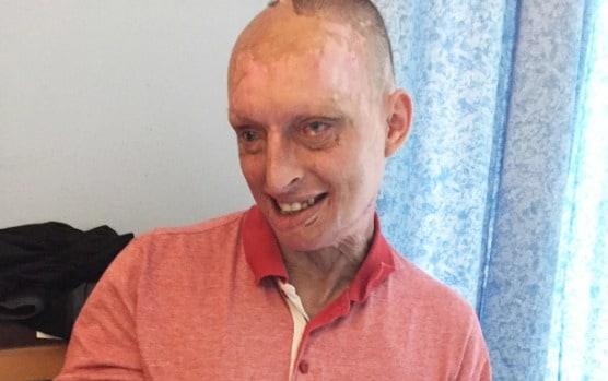 본문 이미지 - 염산 테러를 당한 대니얼 - 더선 갈무리