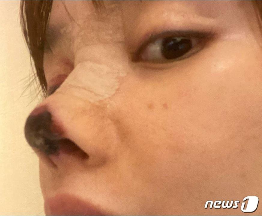 본문 이미지 - 중국 여배우 가오리우가 자신의 성형수술 부작용 사실을 고백했다.(웨이보 갈무리)ⓒ 뉴스1