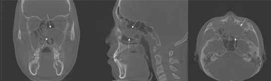 본문 이미지 - 14세 남아의 왼쪽 상악동에 생긴 점액낭종 분석 영상이미지(사진제공=경희대치과병원) ⓒ 뉴스1