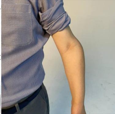 본문 이미지 - 이재명 경기지사가 자신의 페이스북에 공개한 휘어진 왼팔꿈치. 소년공 시절 프레스에 눌려 다치는 바람에 영구장애를 안게 됐으며 이로 인해 군면제 조치를 받았다. (페이스북 갈무리) ⓒ 뉴스1