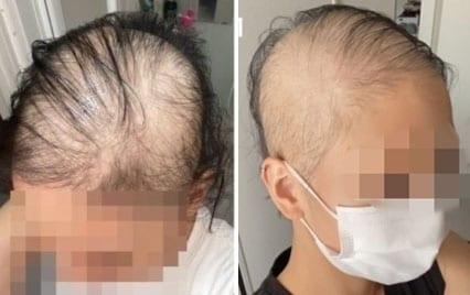 본문 이미지 - 일본의 한 20대 여성이 지난 6월말 모더나 백신 1차 접종을 한 뒤 탈모가 시작됐다며 공개한 사진. (블로그 갈무리) ⓒ 뉴스1