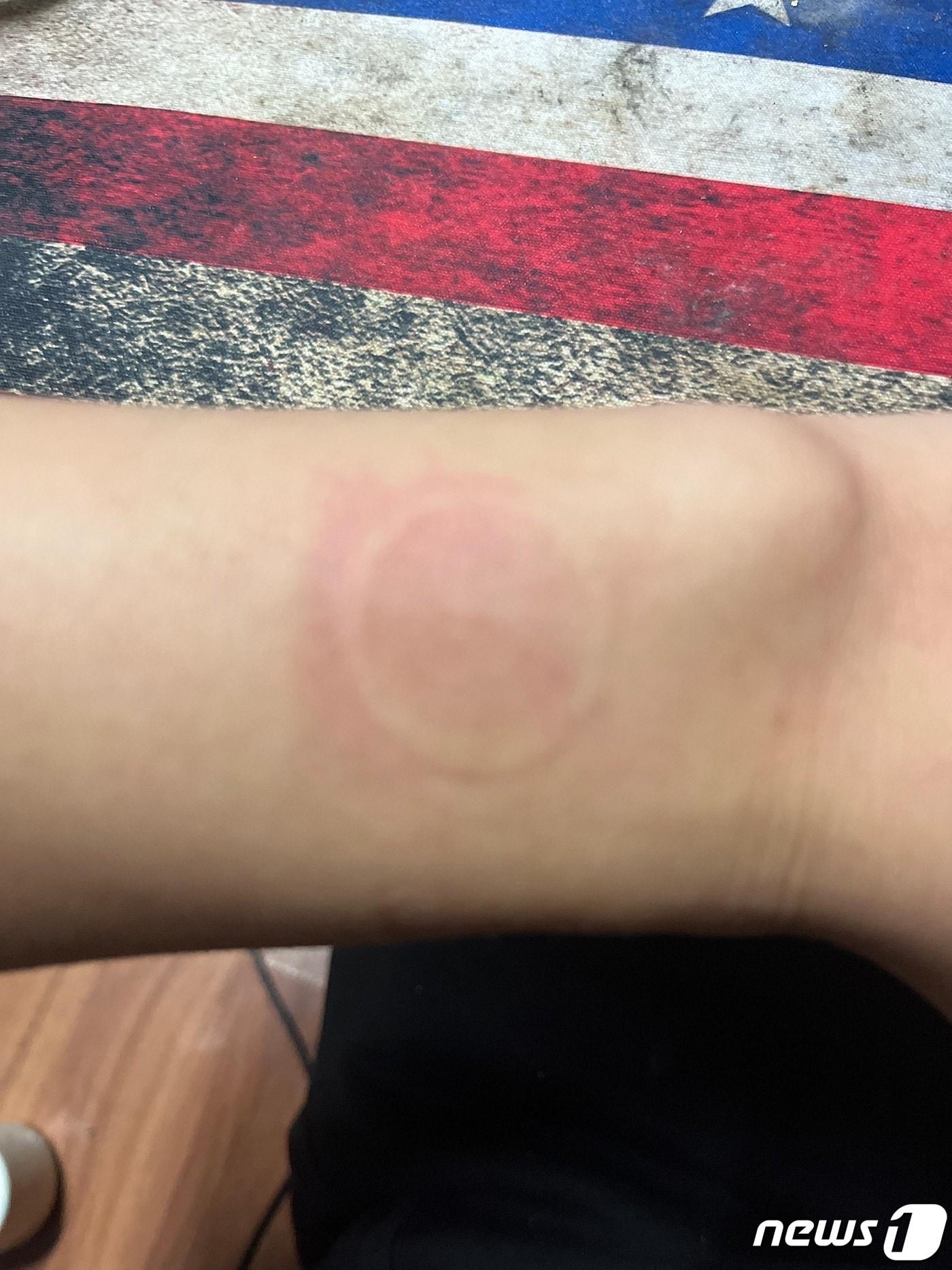 본문 이미지 - 온라인 커뮤니티에 애플워치 사용 중 저온화상을 입었다는 글과 사진이 게재되고 있다. 사진은 애플워치7 사용 중 화상을 입은 모습. <출처=아사모 갈무리> ⓒ 뉴스1