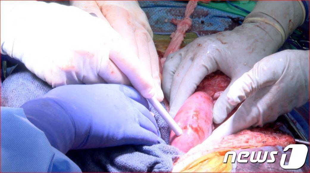 본문 이미지 - 19일(현지시간) 미국 앨러바마대 의료진이 유전자 조작 돼지의 심장을 뇌사 상태 환자의 복부에 이식하고 있다. 2022.01.19 ⓒ AFP=뉴스1