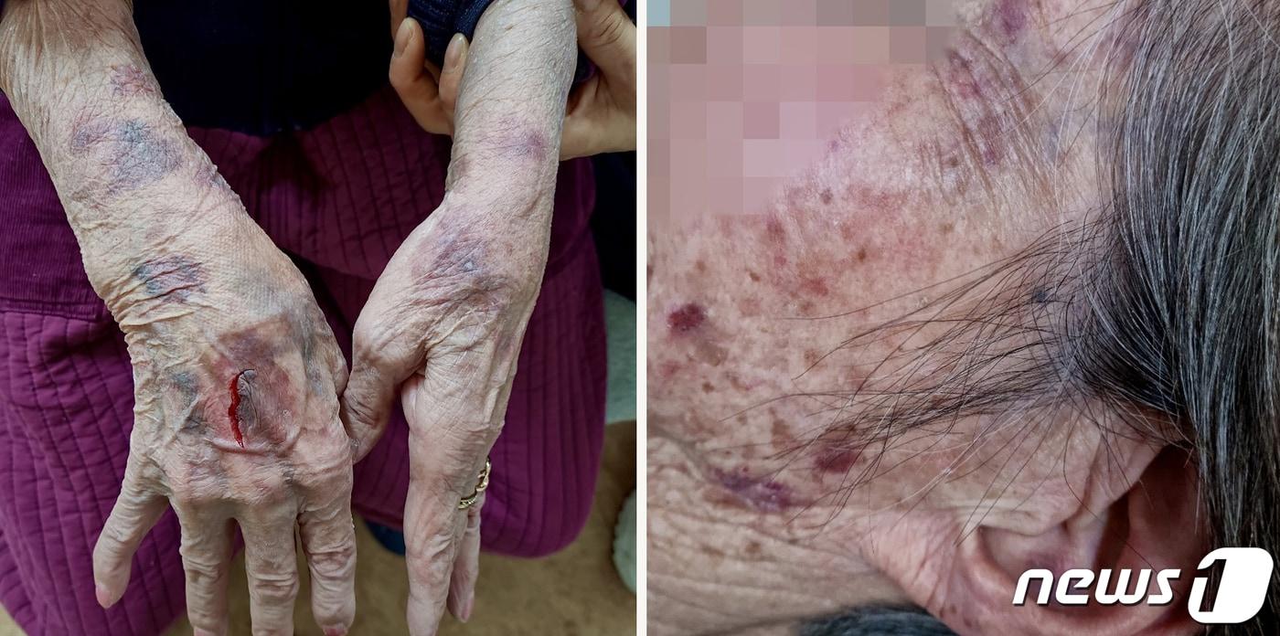 본문 이미지 - 80대 치매할머니가 김천의 한 노인주간보호센터에서 폭행을 당했다고 주장하는 가족이 올린 사진 (네이트 판 갈무리) 2022.1.7/ⓒ 뉴스1