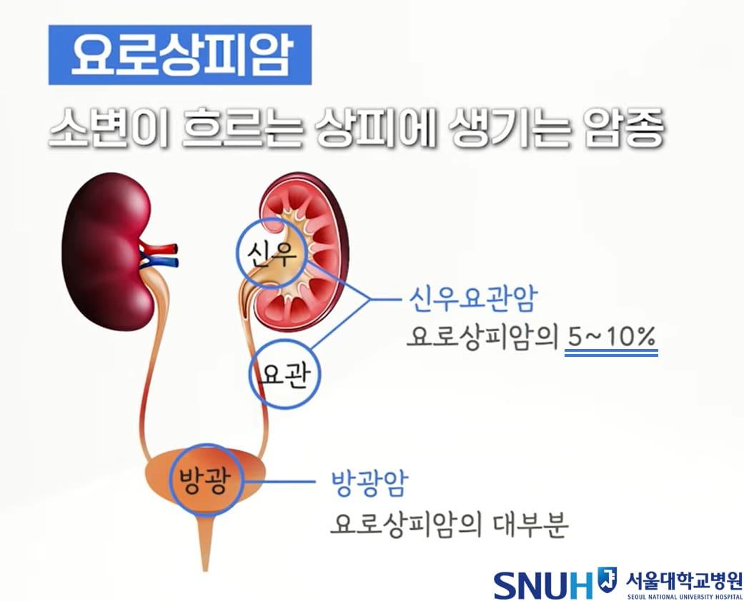 본문 이미지 - 신우요관암 설명(서울대병원 제공) 