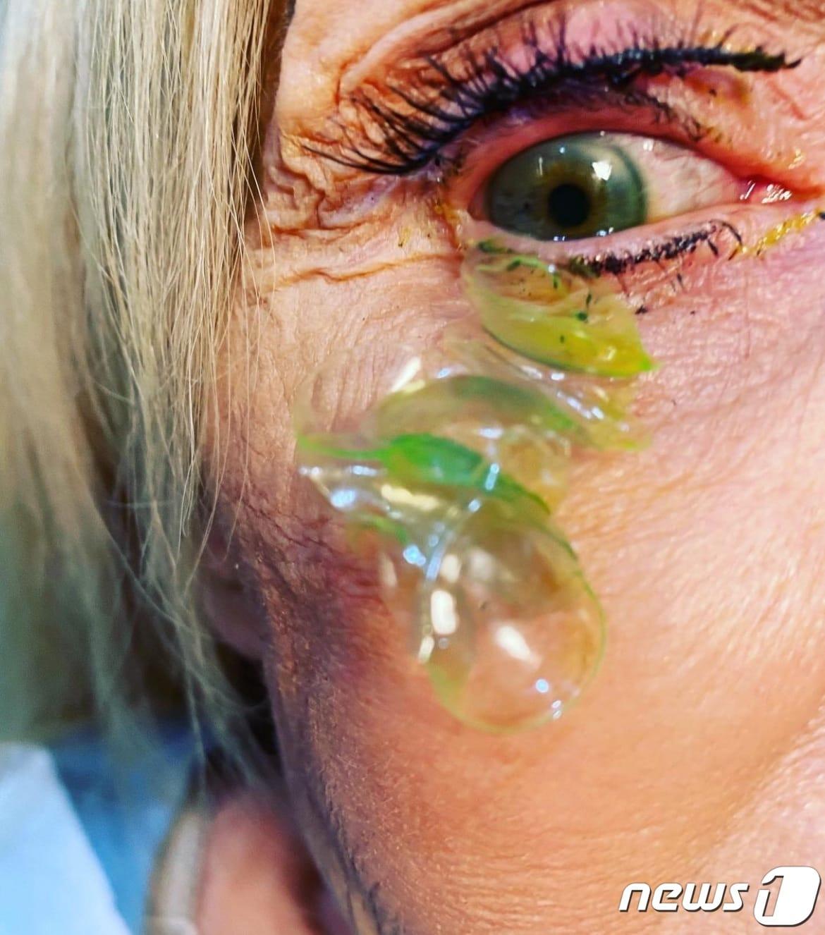 본문 이미지 - 렌즈를 빼는 것을 잊은 70대 중반 여성의 눈에서 총 23개의 콘택트렌즈가 나왔다. (카테리나 커티바 인스타그램)