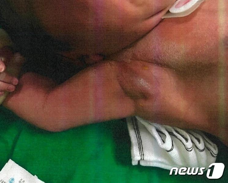 본문 이미지 - 농가진 감염으로 A군의 겨드랑이가 부풀어올랐다.(A군 보호자 진모씨 제공) 