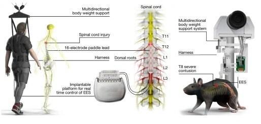 본문 이미지 - 스위스 연구팀이 장막 외 전기자극(EES) 치료를 통해 하반신 마비 환자의 보행능력을 일부 회복시켰다.(연구팀 게재 논문 갈무리)