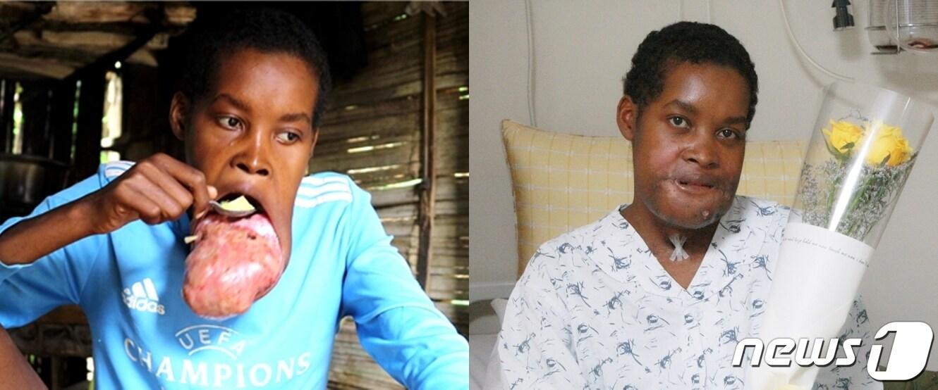 본문 이미지 - '징그러운 혹이 달린 아이'라며 따돌림받던 아프리카 남동쪽 섬나라 마다가스카르 오지 지역의 청년 플란지의 수술 전(왼쪽, 올해 5월)과 수술 후(오른쪽) 비교 사진 (서울아산병원 제공)