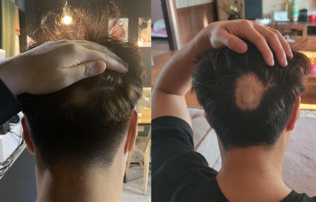 본문 이미지 - 한 남성이 화이자 백신 접종 후 원형 탈모가 생겼다고 주장했다. 왼쪽은 지난해 화이자 1차 맞고 2주 뒤, 오른쪽은 3일 오전 촬영한 사진. (온라인 커뮤니티 갈무리) ⓒ 뉴스1