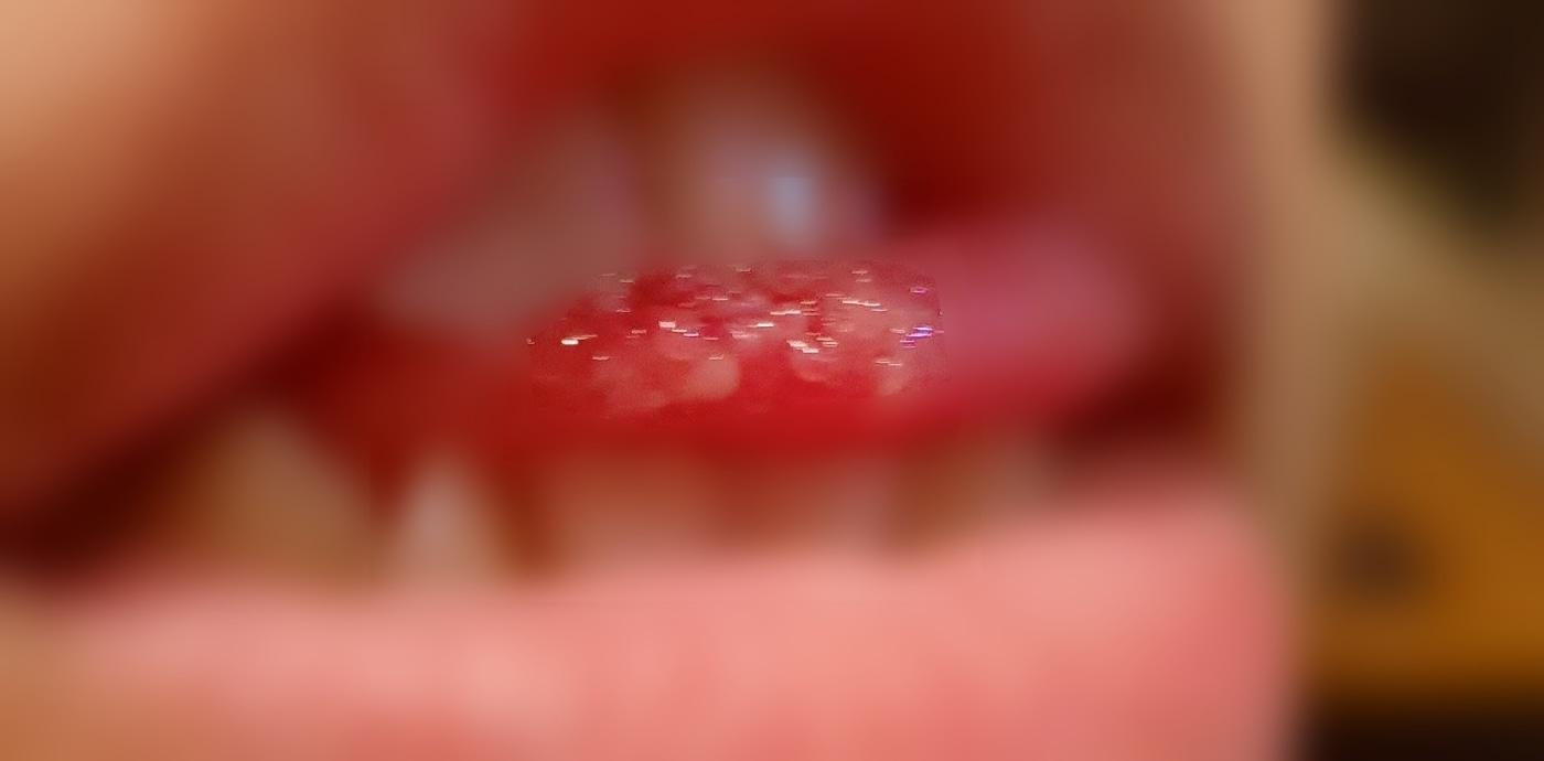 락스가 닿은 혀에 설유두가 올라왔다고 주장하는 사진. (온라인 커뮤니티 갈무리) ⓒ 뉴스1