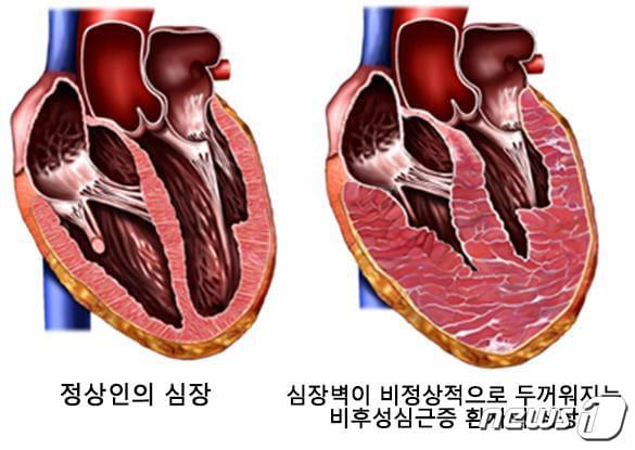 본문 이미지 - 비후성심근증 모식도 ⓒ 뉴스1
