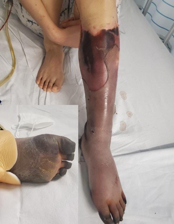 본문 이미지 - 청원을 작성한 남성이 공개한 여자친구의 입원 당시 다리 상태 (온라인 커뮤니티 갈무리) ⓒ 뉴스1
