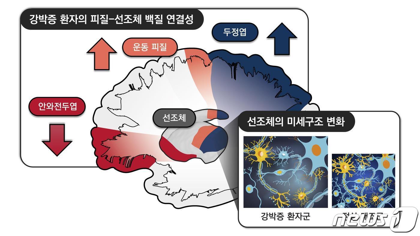 강박증 환자에서 관찰한 대뇌 피질-선조체 회로의 변화 (서울대학교병원 제공) ⓒ 뉴스1