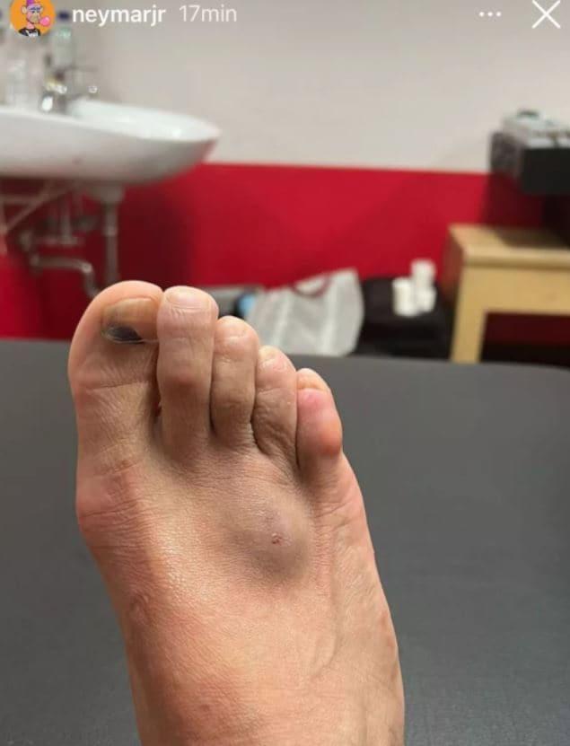 본문 이미지 - 네이마르의 부어오른 발등(네이마르 SNS)ⓒ 뉴스1