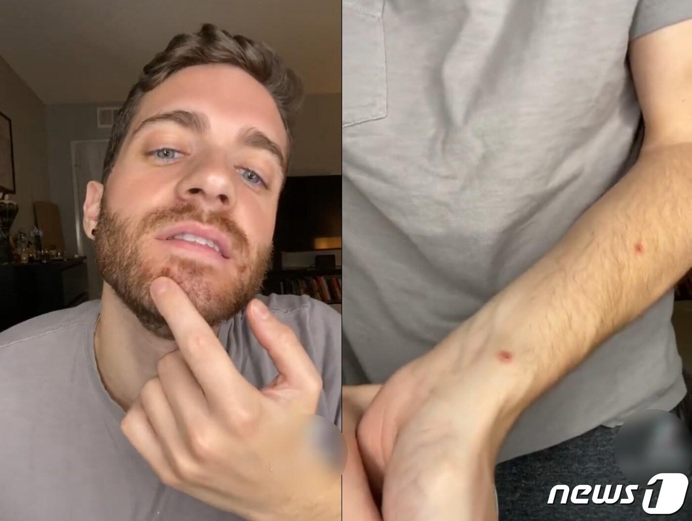 본문 이미지 - 원숭이두창에 감염됐다고 밝힌 맷 포드(30). (틱톡 갈무리) ⓒ 뉴스1