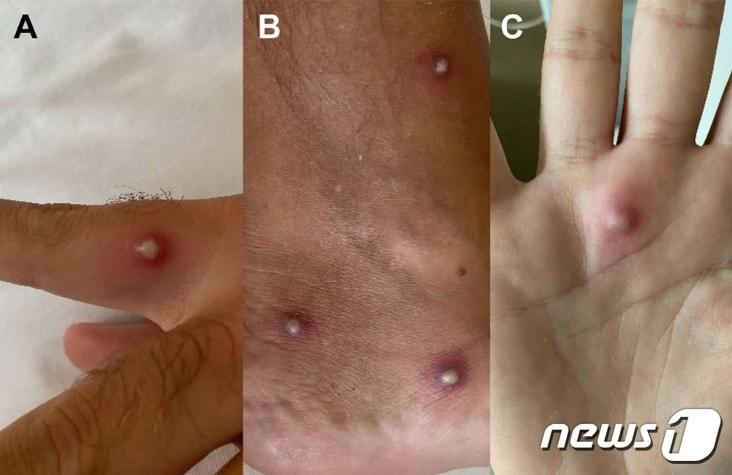 본문 이미지 - 환자에게서 발견된 피부 발진 - BBC 갈무리