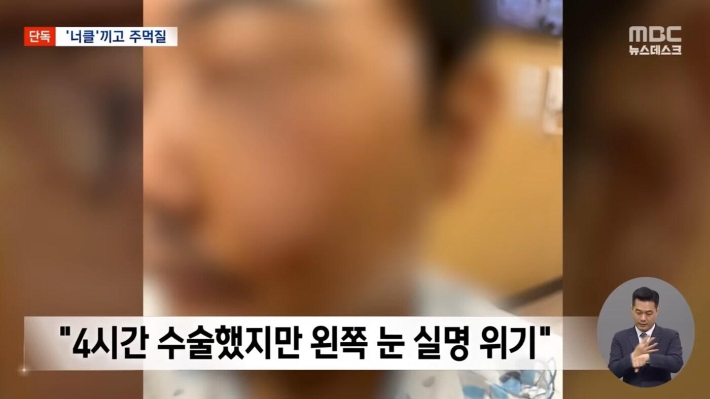 A군이 너클을 끼고 안경 낀 B씨를 폭행, B씨는 실명 위기에 이르렀다. (MBC)