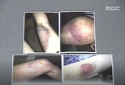 본문 이미지 - 2006년 청주 학폭 피해 여중생이 고데기 열과 폭행 등으로 입은 상처. (MBC)