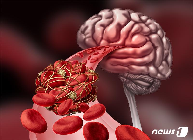 본문 이미지 - 고령화로 인해 심근경색증과 뇌졸중 등 심뇌혈관질환 발생이 늘고 있다. 심근경색 환자 16.1%, 뇌졸중 환자 19.8%는 발병 1년 안에 사망했다. ⓒ News1 윤주희 디자이너