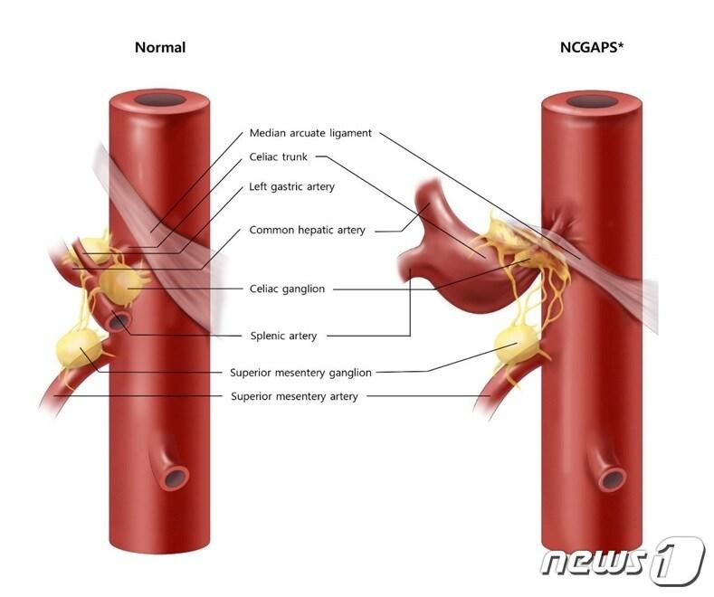 본문 이미지 - 호두까기복통이 있는 경우(오른쪽) 정상인 왼쪽과 달리 정중궁인대가 복강동맥(Celiac Trunk)을 가로지르며 복강신경절을 눌러 통증을 유발한다/삼성서울병원 제공