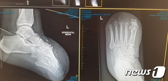 본문 이미지 - 이상국씨 발가락 절단 엑스레이 사진(이상국씨 제공) ⓒ 뉴스1 