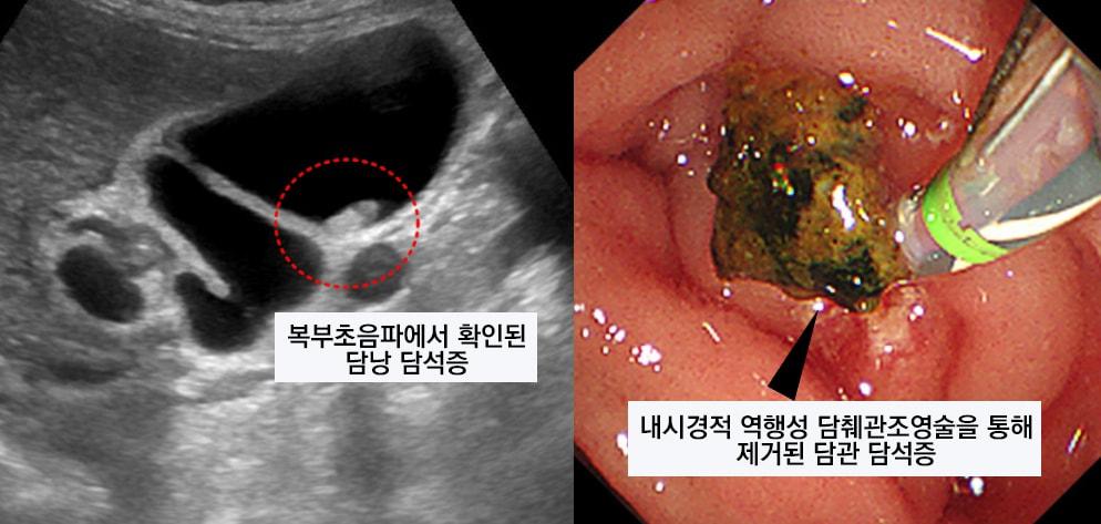 본문 이미지 - 복부초음파(왼쪽), 내시경적 역행성 담췌관조영술(ERCP)를 통해 확인된 담석증(오른쪽)/순천향대학교 부천병원 제공