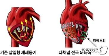 본문 이미지 - 기존 임상에서 사용 중인 삽입형 제세동기와 다채널 전극 어레이의 구조 비교. (기초과학연 제공) /뉴스1