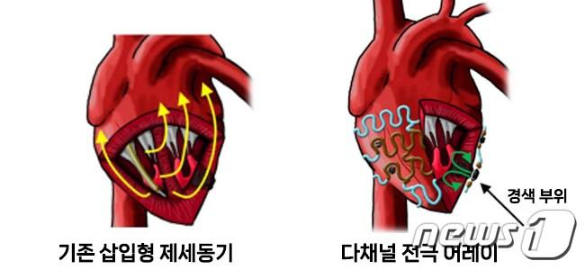 본문 이미지 - 삽입형 제세동기와 다채널 전극 어레이의 구조/서울대학교병원 제공